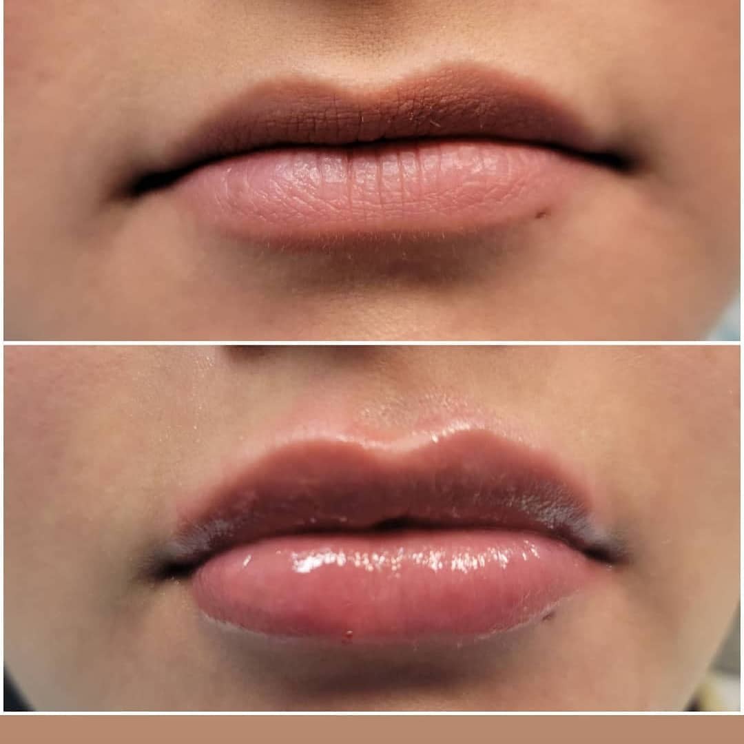 Lip filler natural results Park Ridge dentist