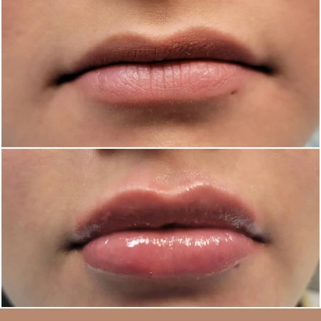 Before and after lip filler treatment adding volume and definition to the lips, Loukas Dentistry of Park Ridge, Illinois