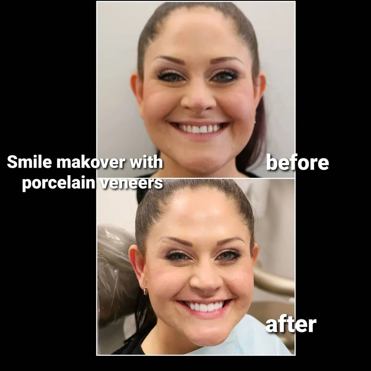 Before Smile makeover with veneers