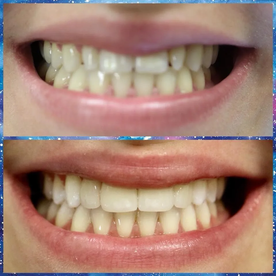 After Smile makeover with veneers