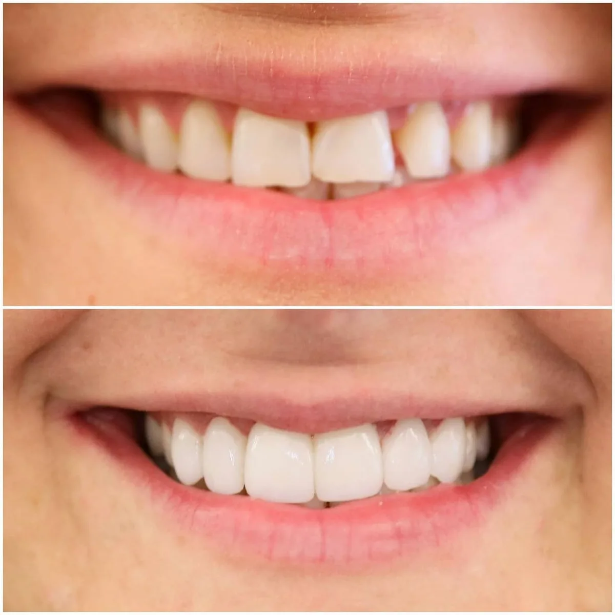 Before Cosmetic veneer case