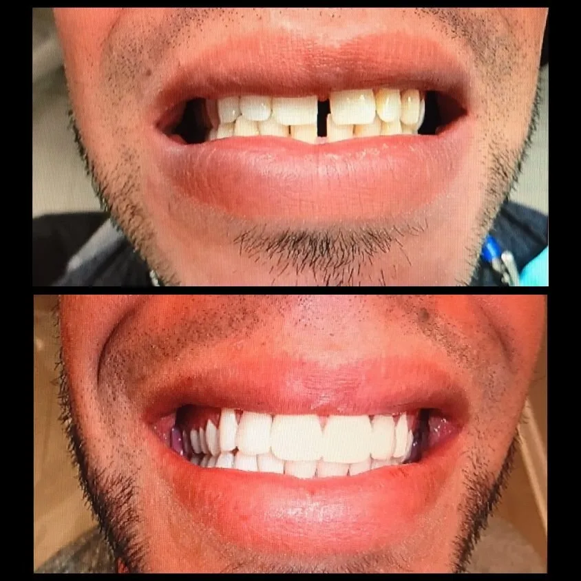 After Cosmetic veneer case