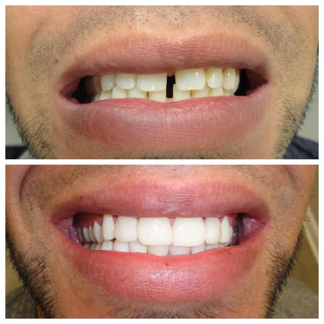Before Veneers with whitening
