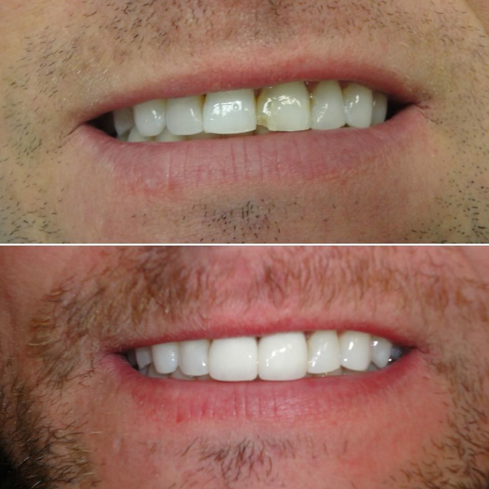 After Veneers with whitening