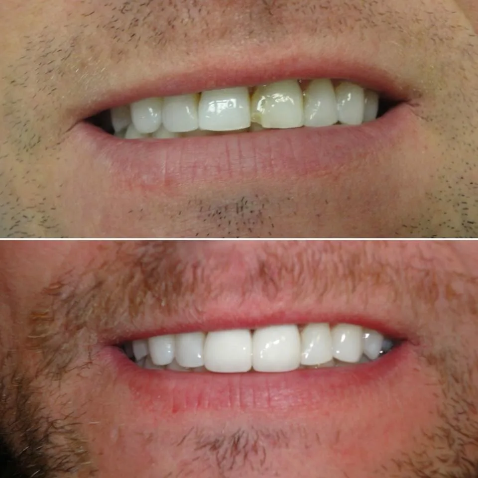 After Veneers with whitening