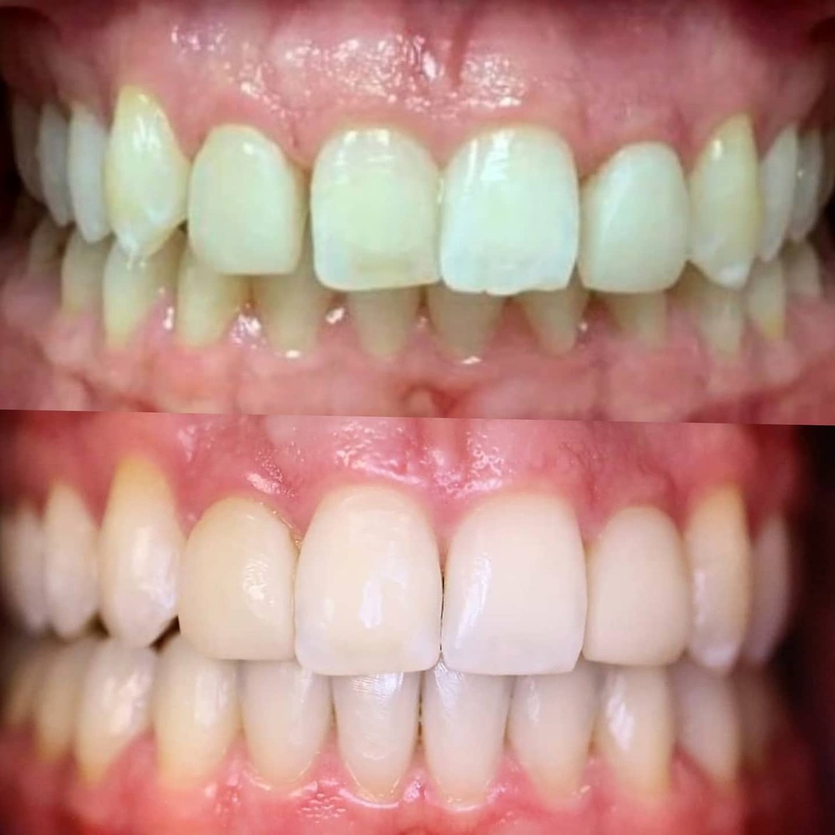 Before In-office whitening results