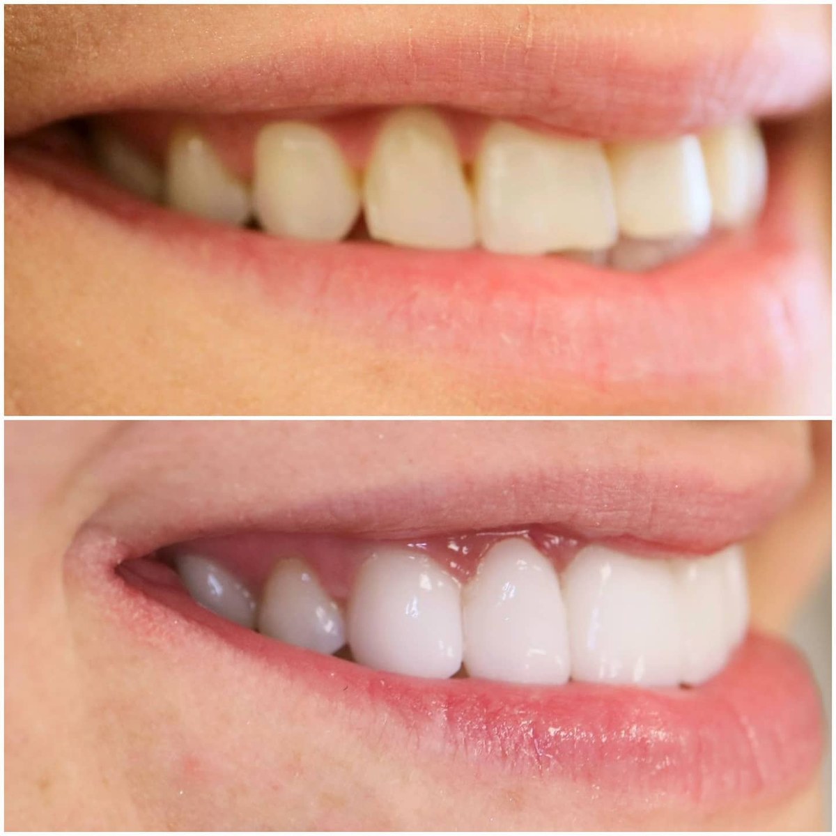 After In-office whitening results