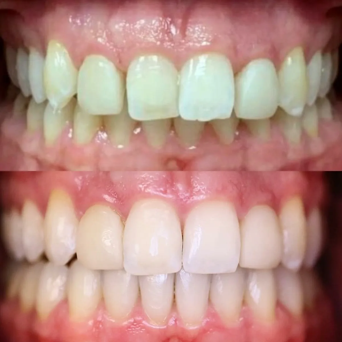 Before and after porcelain restorations reshaping and evening out the upper front teeth, Loukas Dentistry of Park Ridge, Illinois