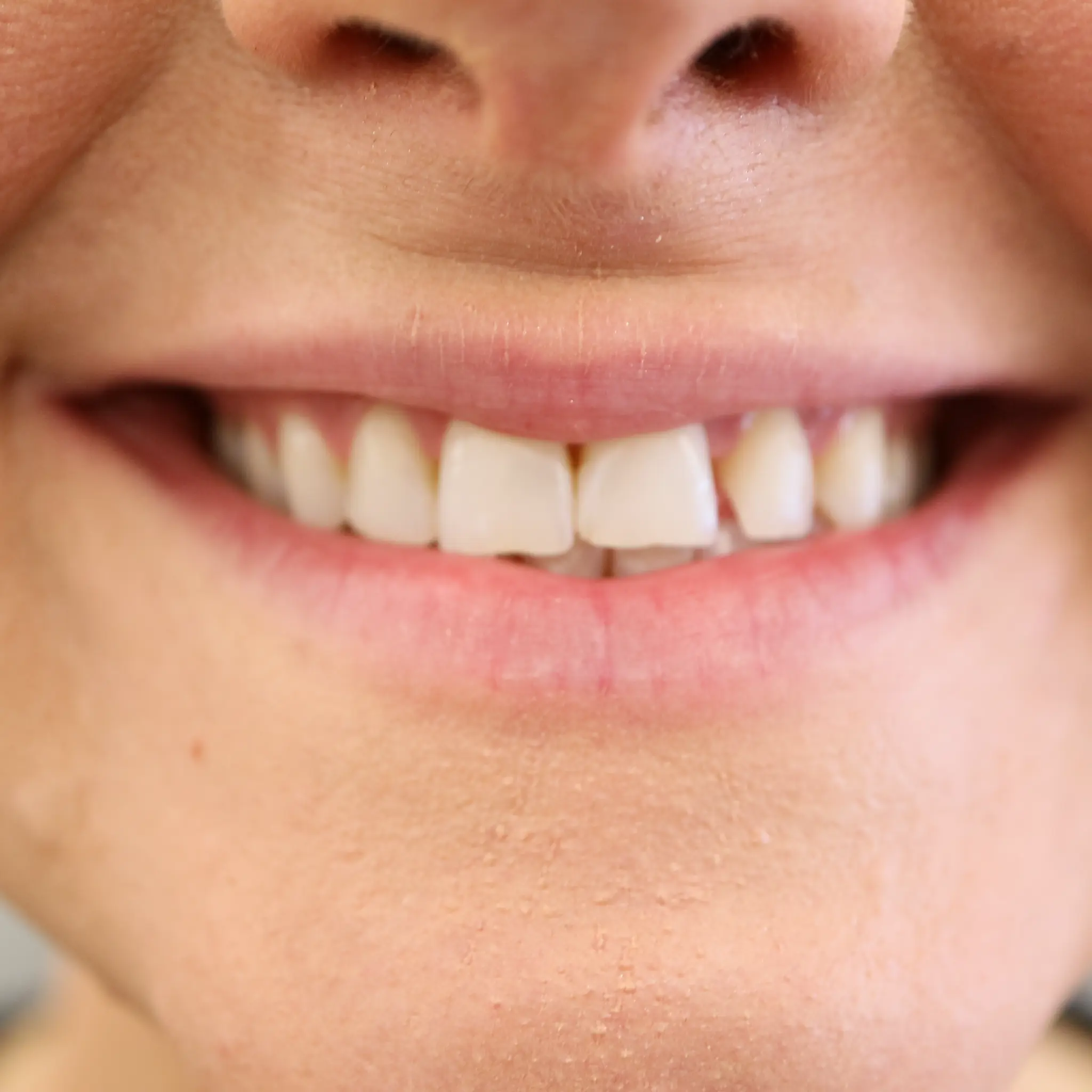 Teeth whitening smile result at Loukas Dentistry