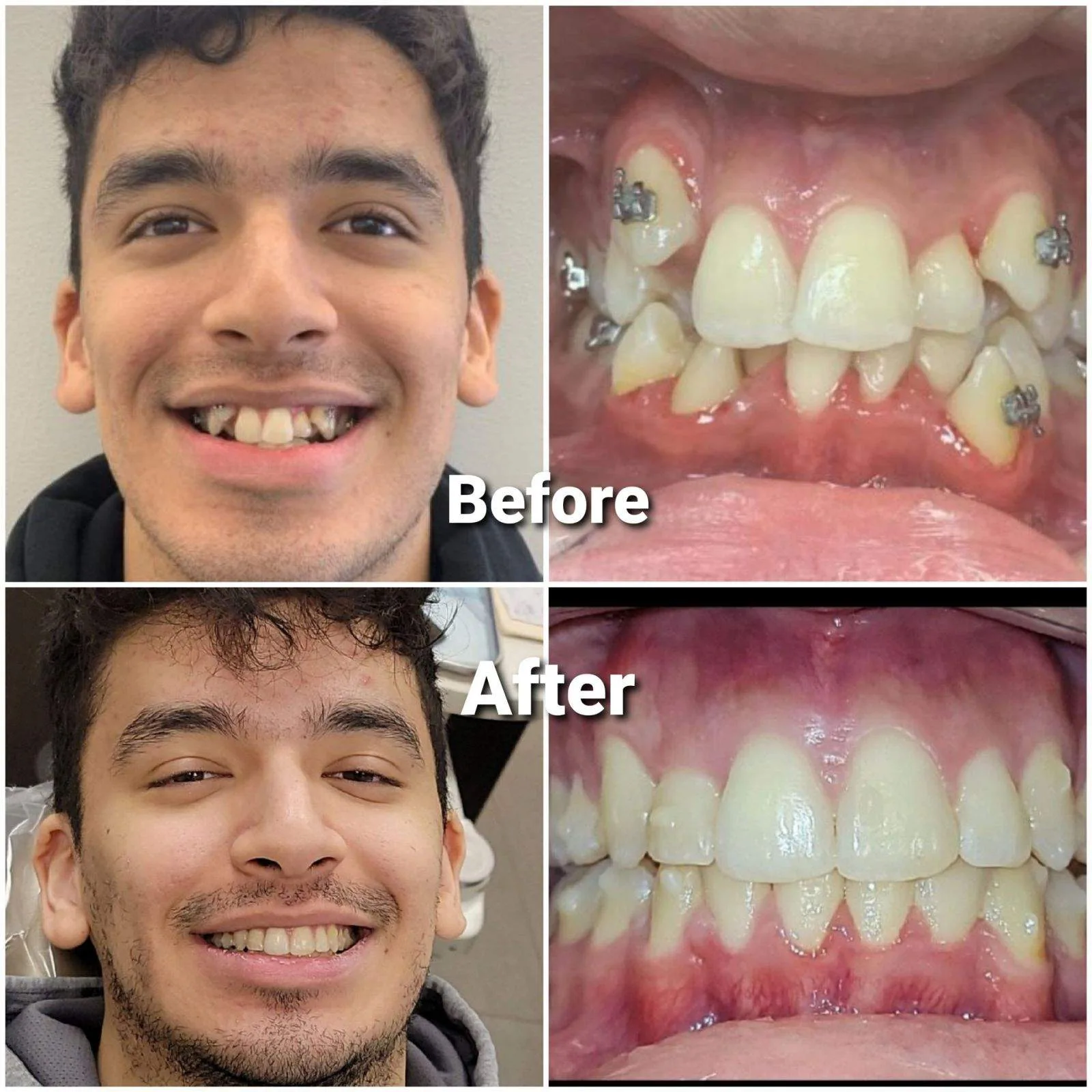 Invisalign before and after photo showing teeth straightening results at Loukas Dentistry Park Ridge IL