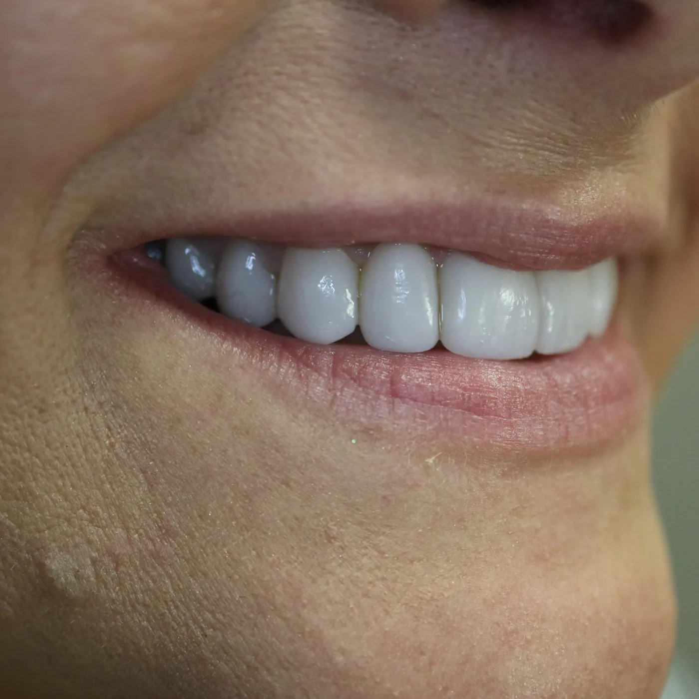 Porcelain Veneers Result