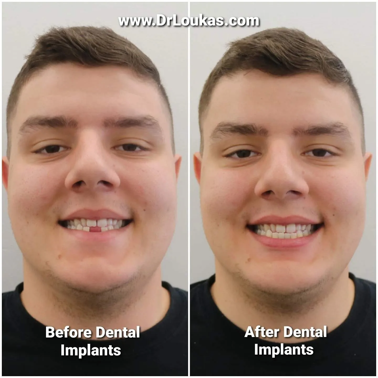 Dental implant before and after transformation at Loukas Dentistry in Park Ridge