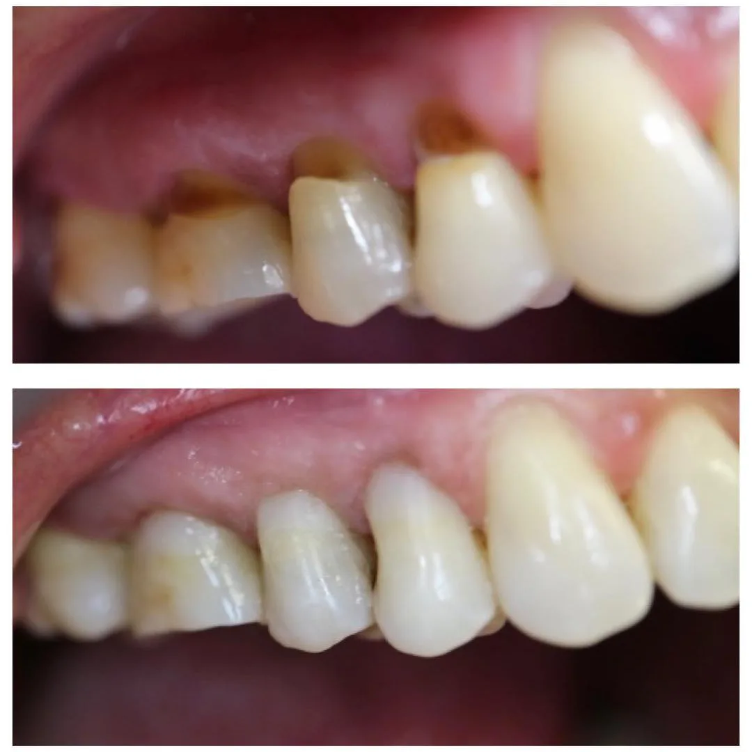 Buccal composite restoration covering an exposed tooth root from gum recession, relieving cold sensitivity
