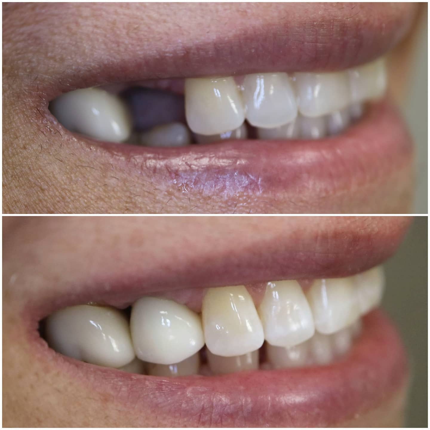 Dental implant before and after at Loukas Dentistry