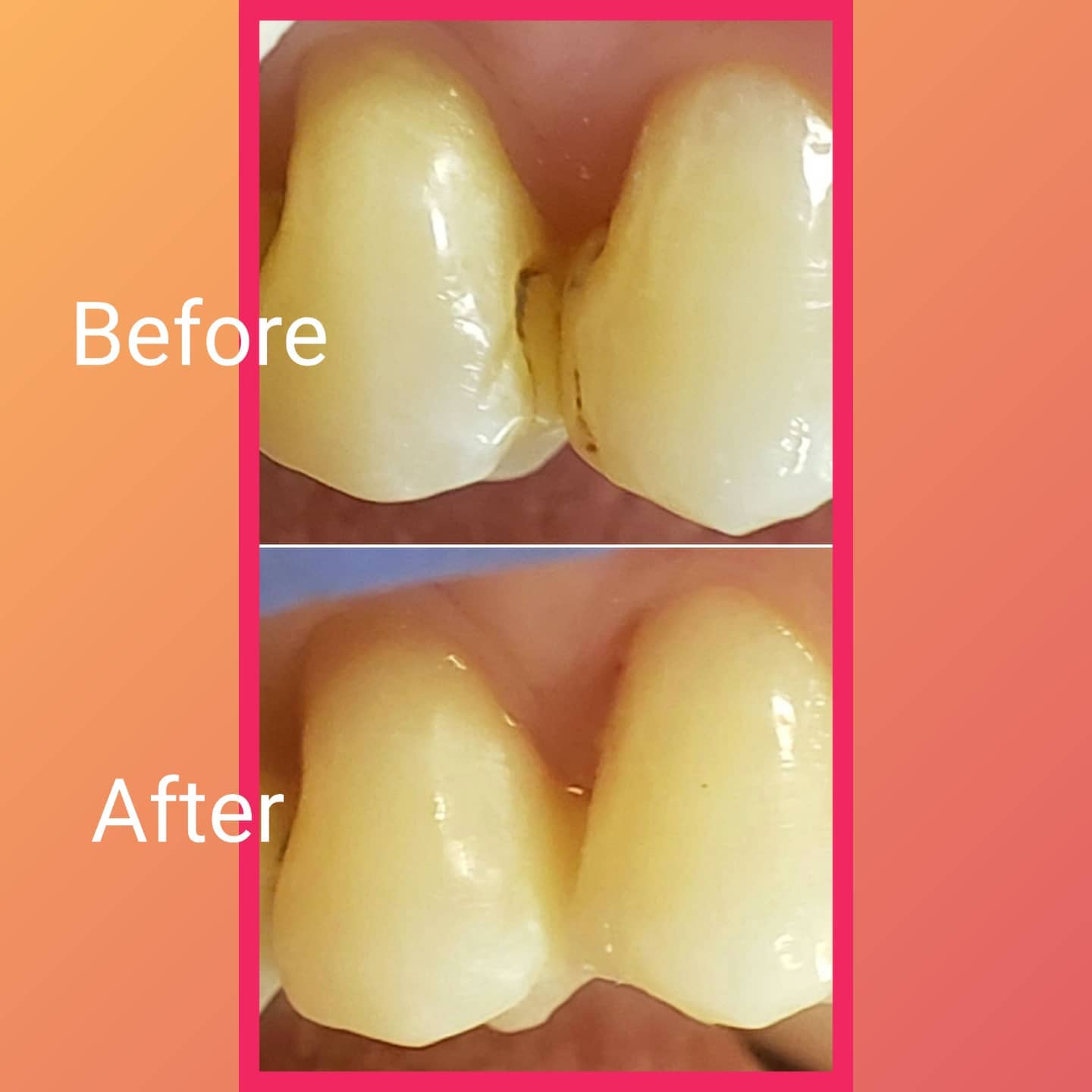 White filling before and after