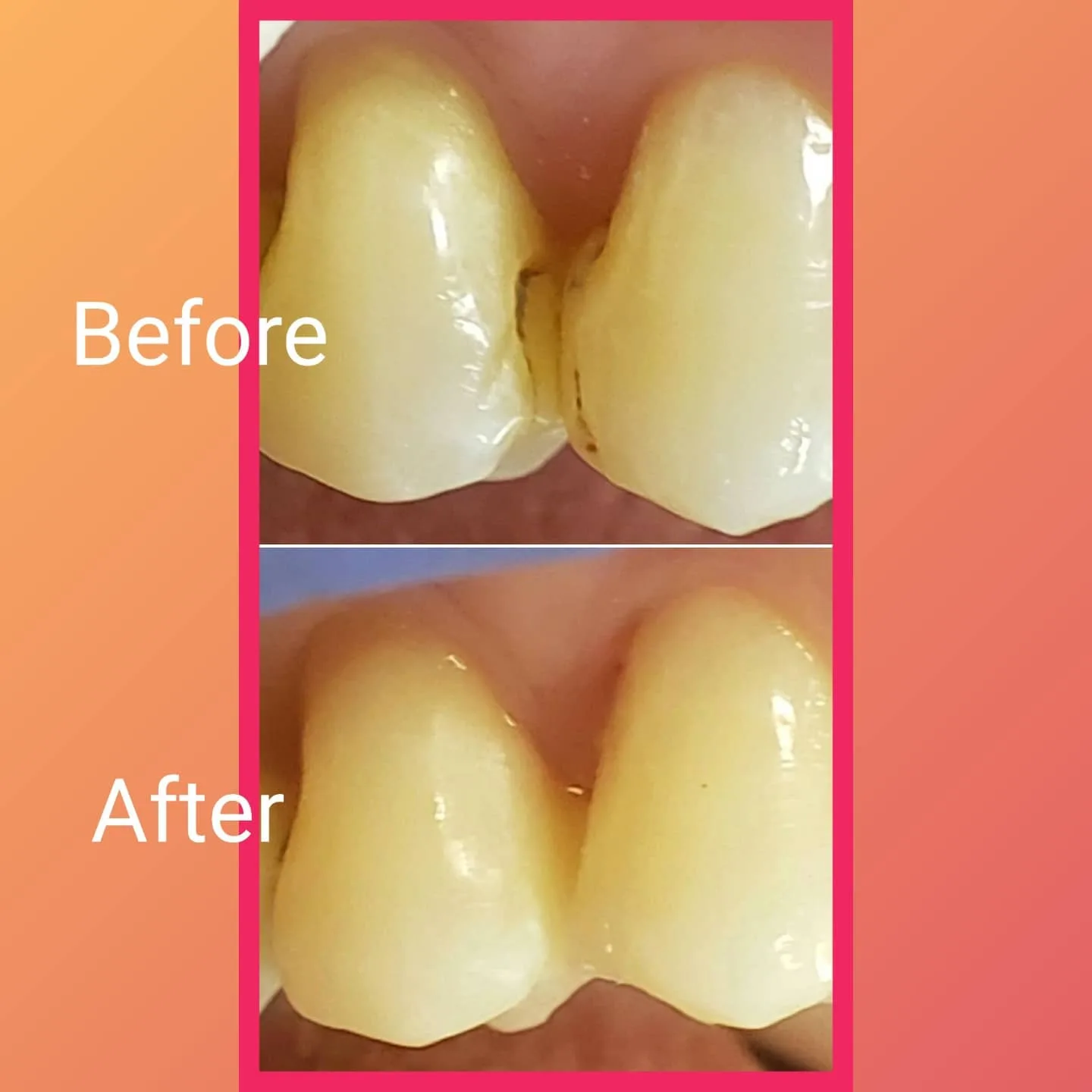 Before and after a small chip and cavity between the front teeth repaired with a composite filling that matches the natural tooth, Park Ridge, IL