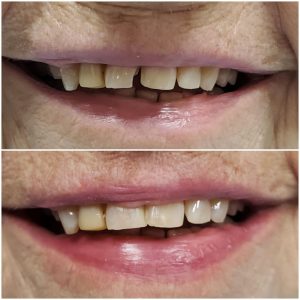 Dental bonding before and after photo showing chipped teeth restored with composite bonding at Loukas Dentistry Park Ridge IL