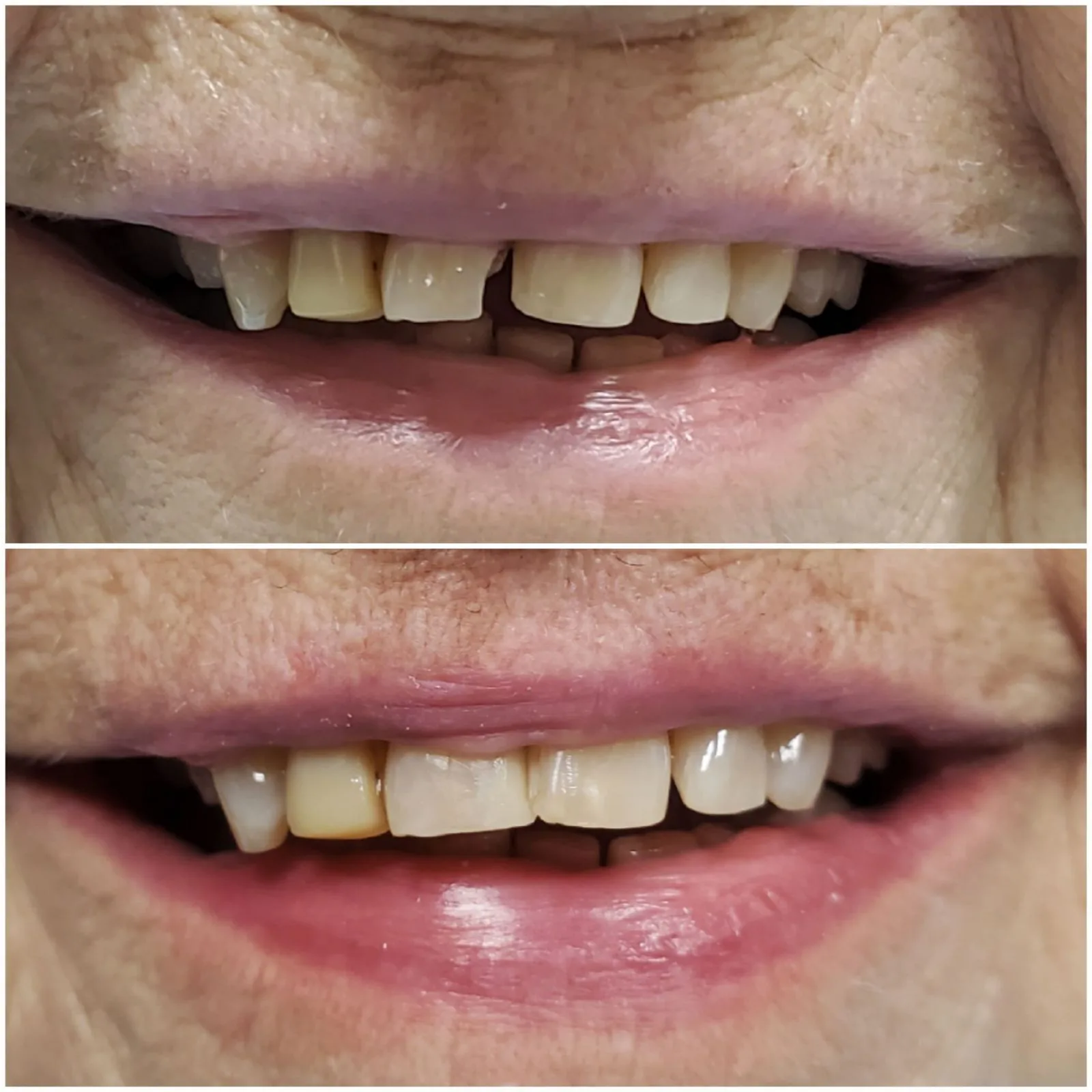 Dental bonding before and after photo showing chipped teeth restored with composite bonding at Loukas Dentistry Park Ridge IL