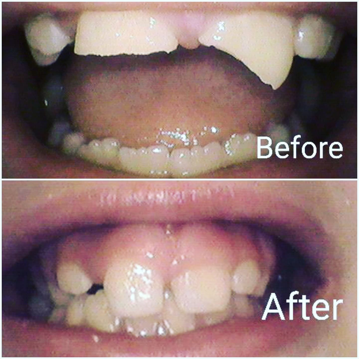 Composite bonding result