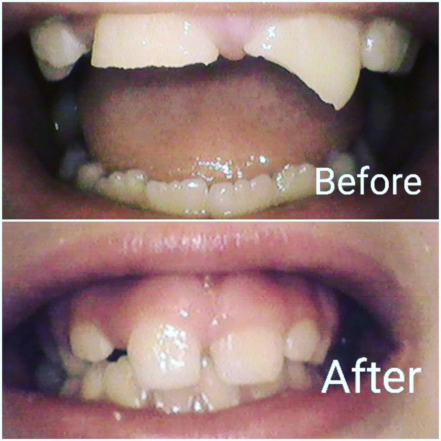 Composite bonding result