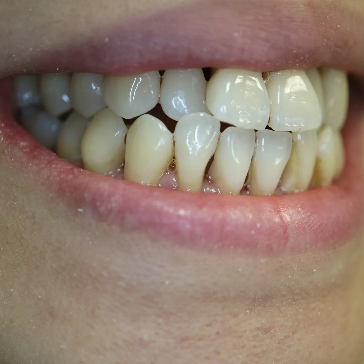 After professional dental cleaning, clean teeth and healthy gums