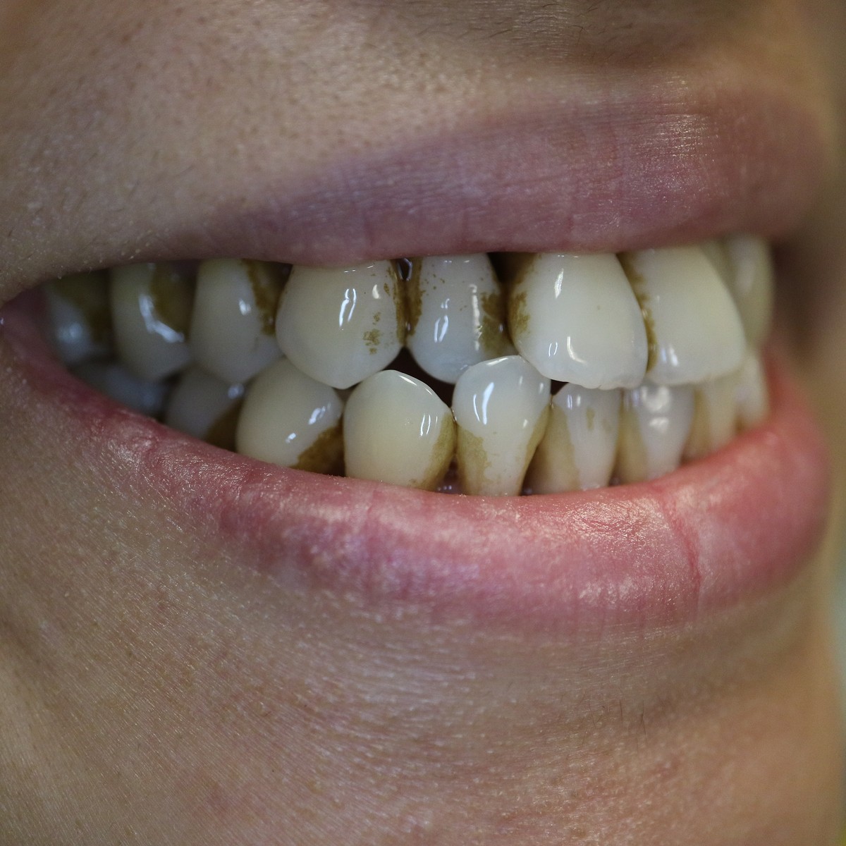 Before professional dental cleaning, heavy tartar buildup