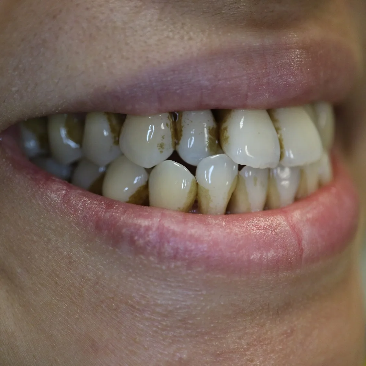Before professional dental cleaning, heavy tartar buildup