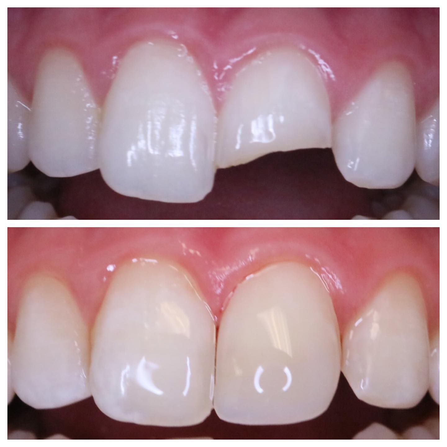 Composite bonding before and after