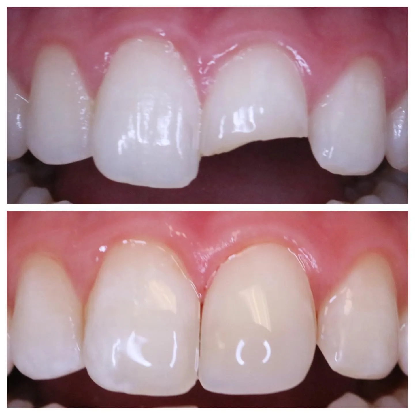 Before and after a fractured front tooth rebuilt to its natural shape and length with composite bonding, Loukas Dentistry of Park Ridge, IL