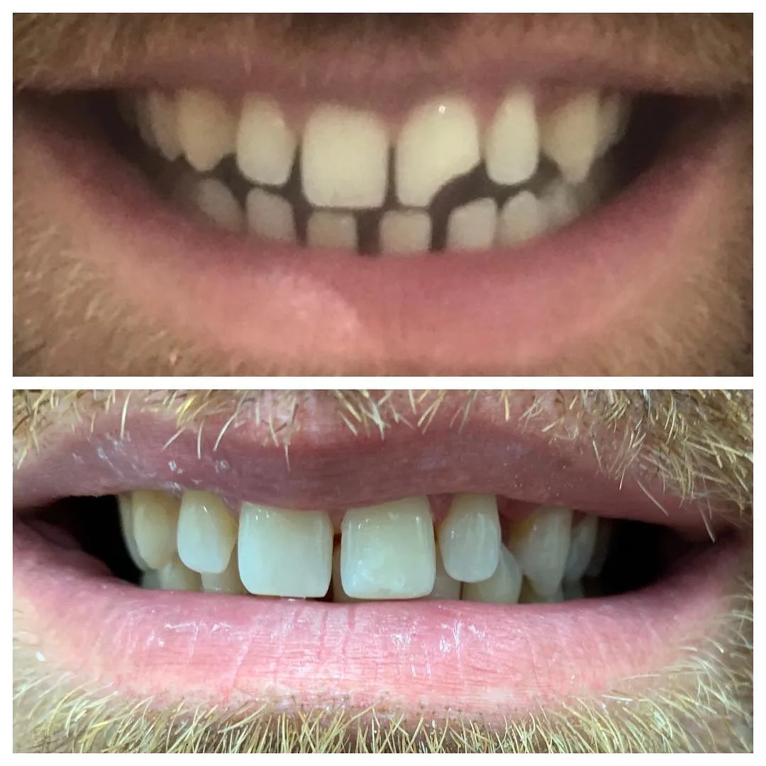Before and after gaps between the front teeth closed with composite bonding in a single appointment, Loukas Dentistry of Park Ridge, IL