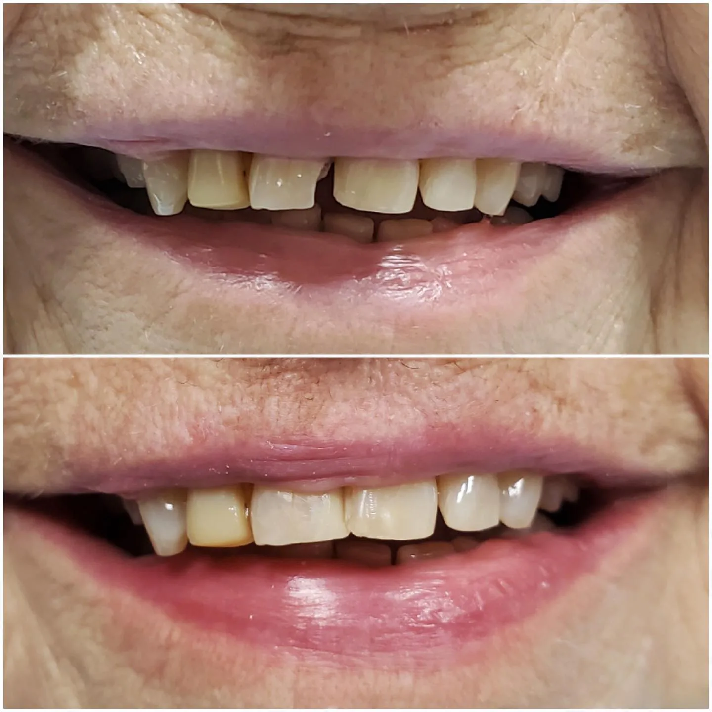Composite bonding