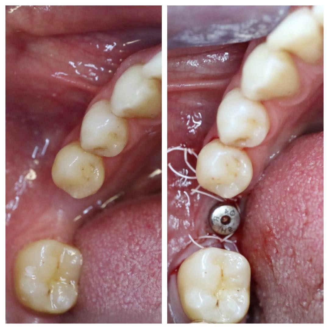 Dental implant result at Loukas Dentistry