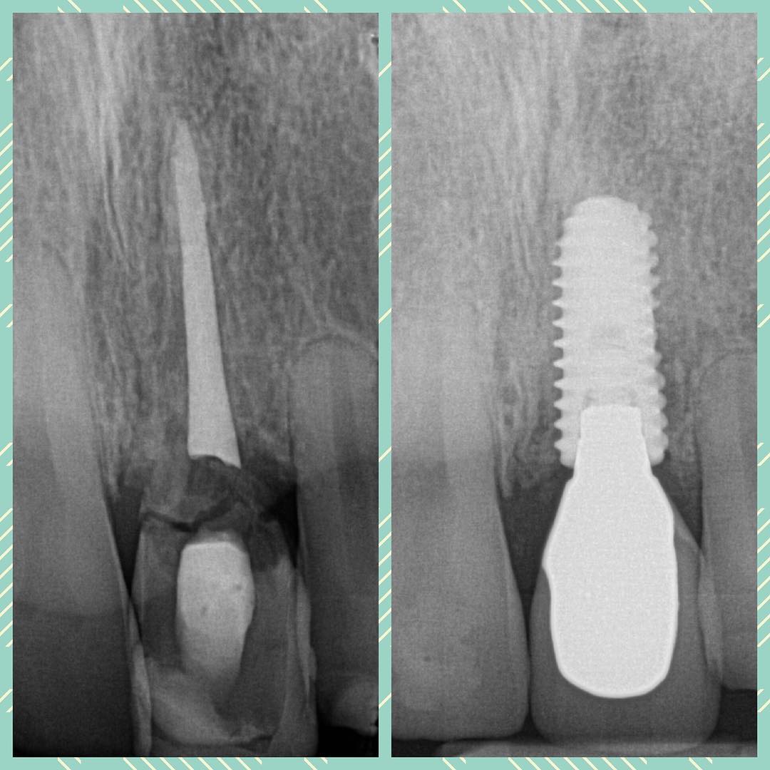 Dental implant x-ray showing osseointegration