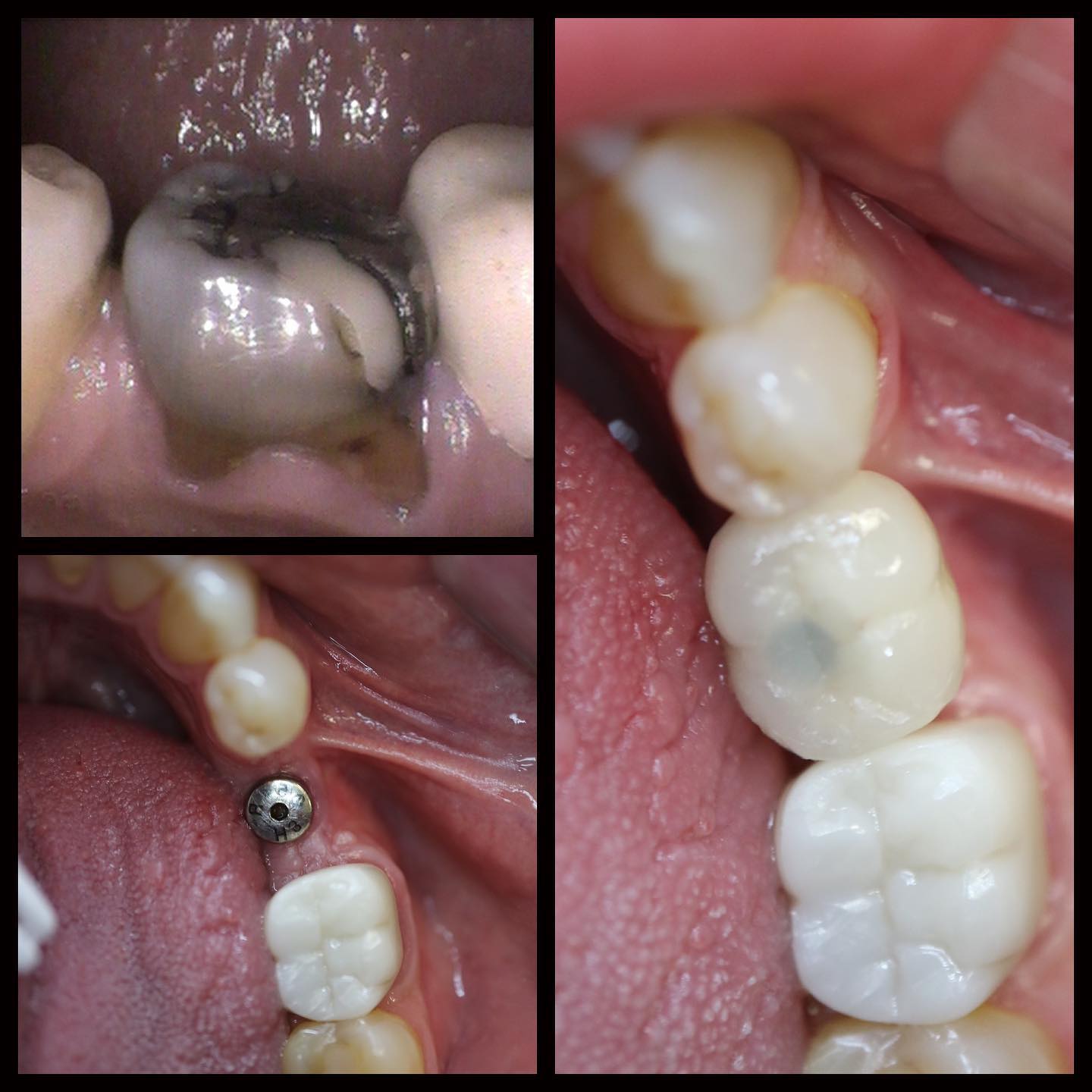 Single tooth dental implant before and after