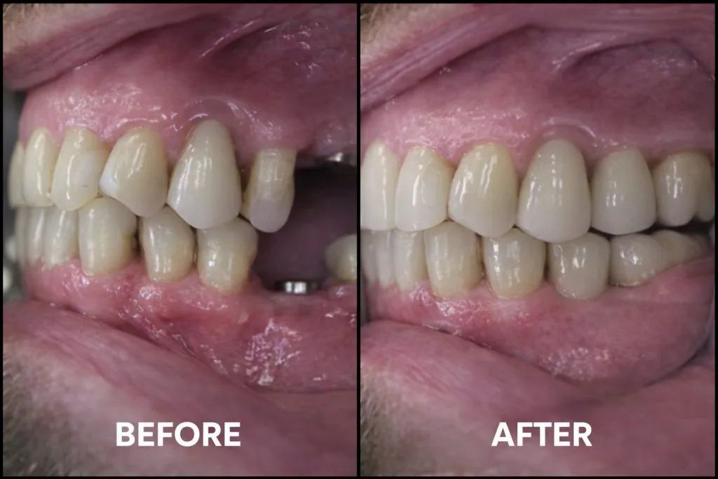 Dental implants before and after photo showing missing implant abutment restored with full implant crown at Loukas Dentistry Park Ridge IL