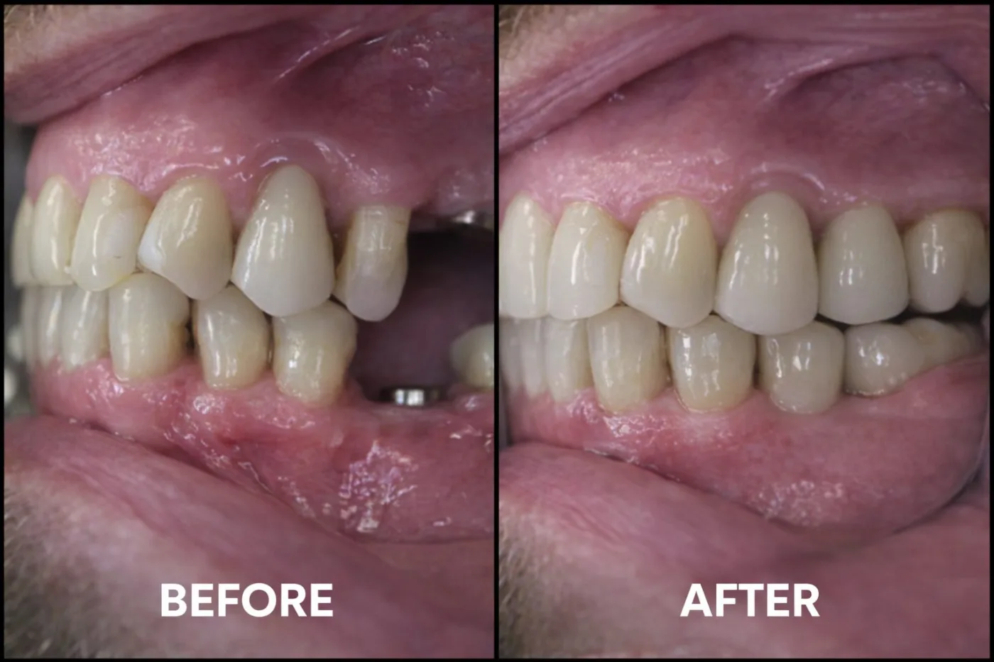 Dental Implants Before and After