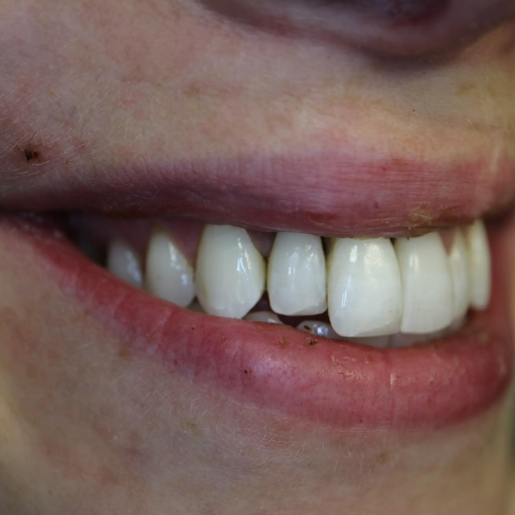 Side view of restored smile after dental trauma treatment at Loukas Dentistry Park Ridge IL