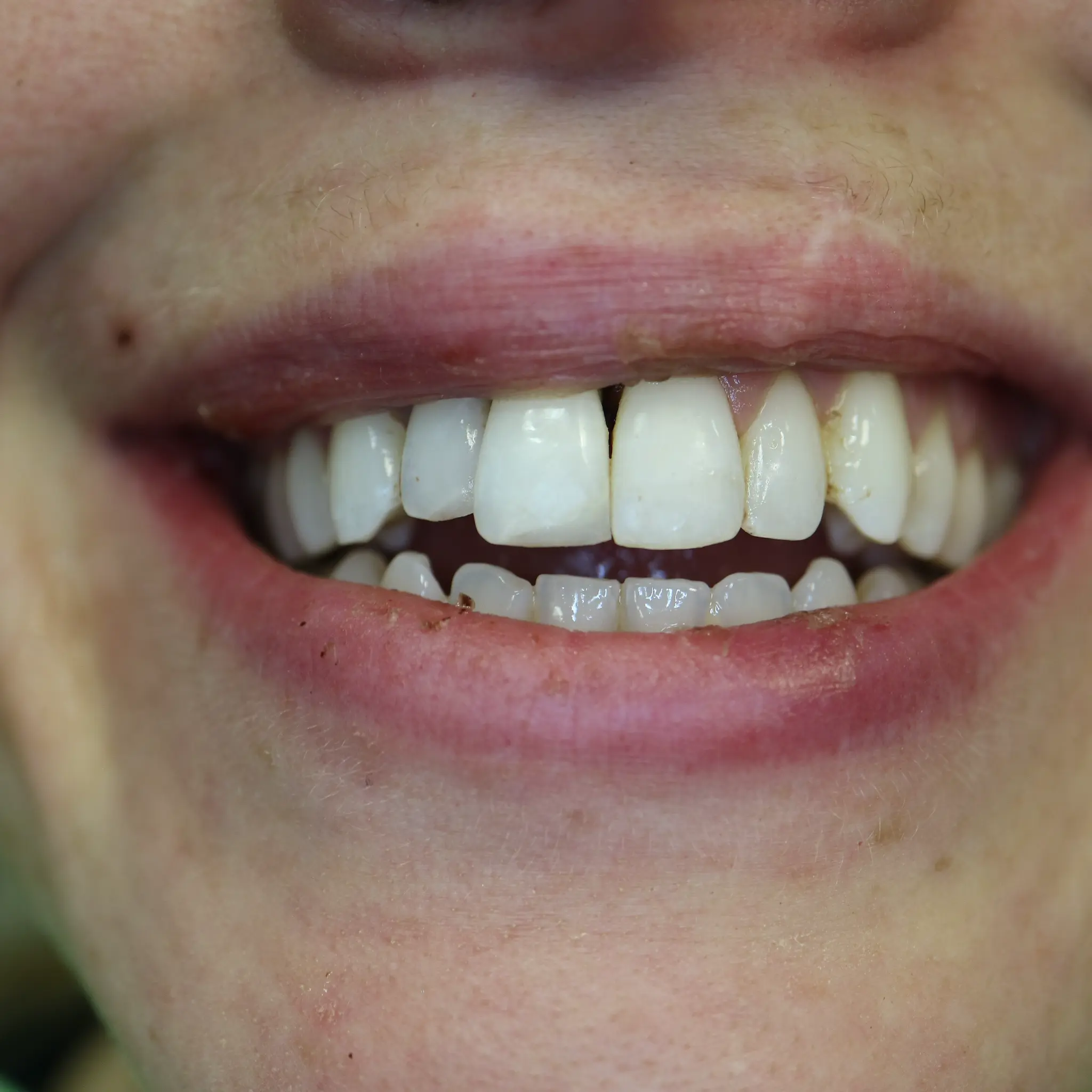 After emergency treatment showing splinted teeth and restored smile at Loukas Dentistry Park Ridge IL