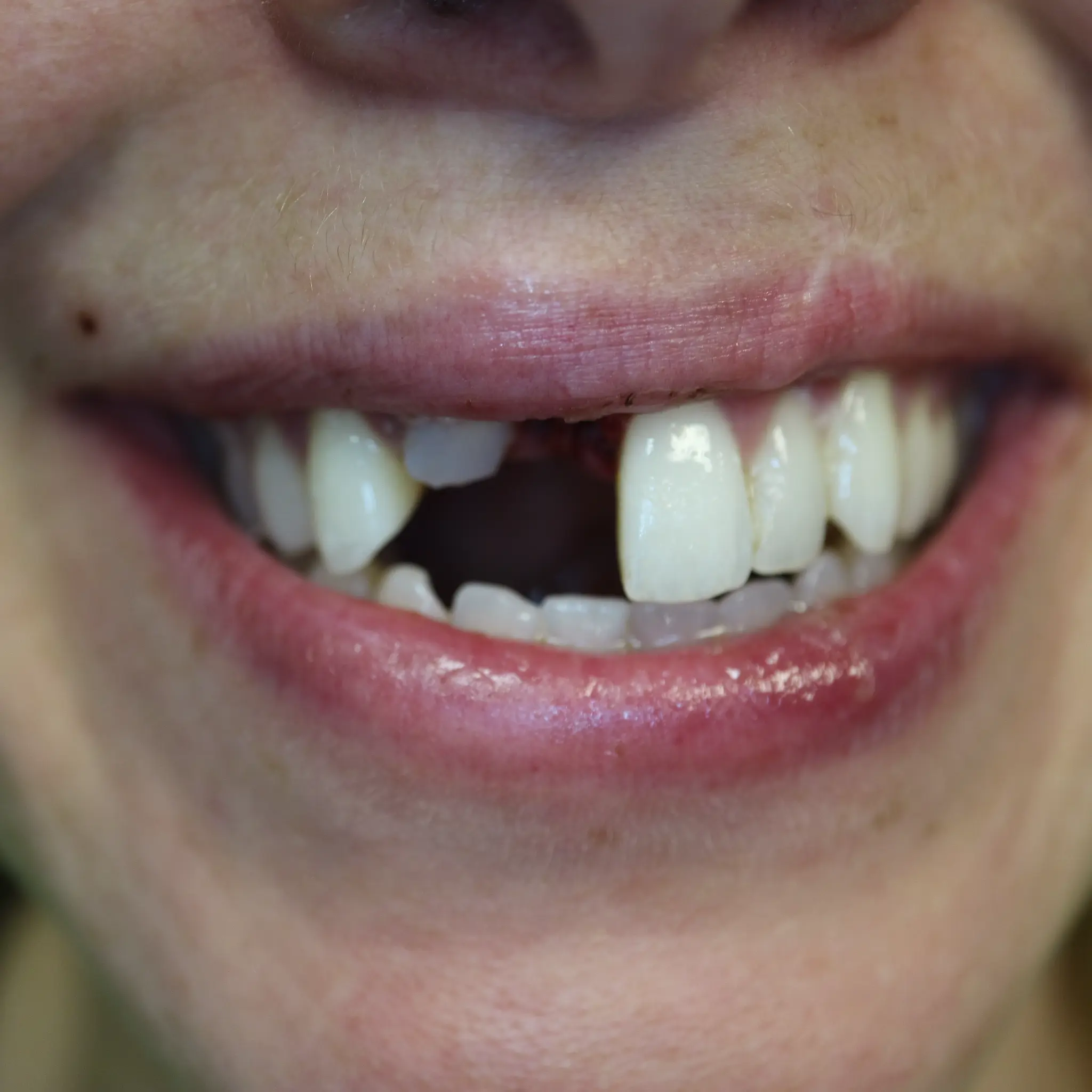 Dental trauma before treatment showing avulsed front tooth at Loukas Dentistry Park Ridge IL