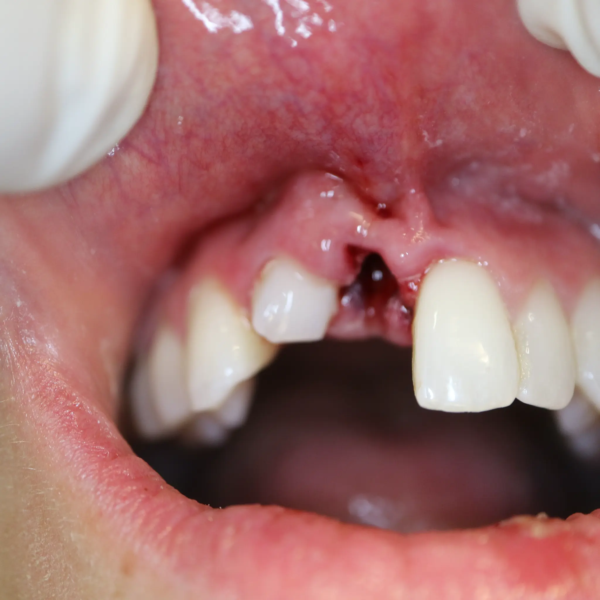 Close-up of avulsed tooth socket showing bleeding and displaced lateral incisor at Loukas Dentistry Park Ridge