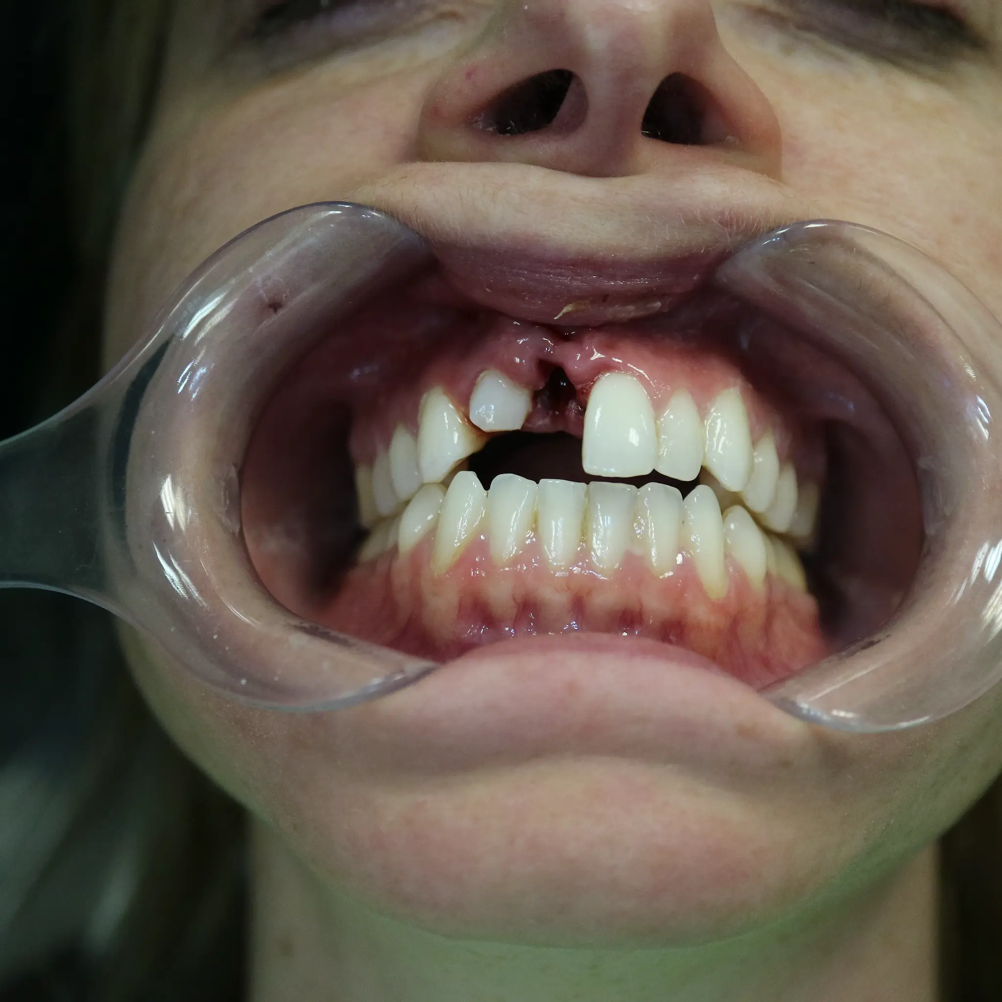 Clinical retracted view showing avulsed tooth socket and intruded lateral incisor at Loukas Dentistry Park Ridge