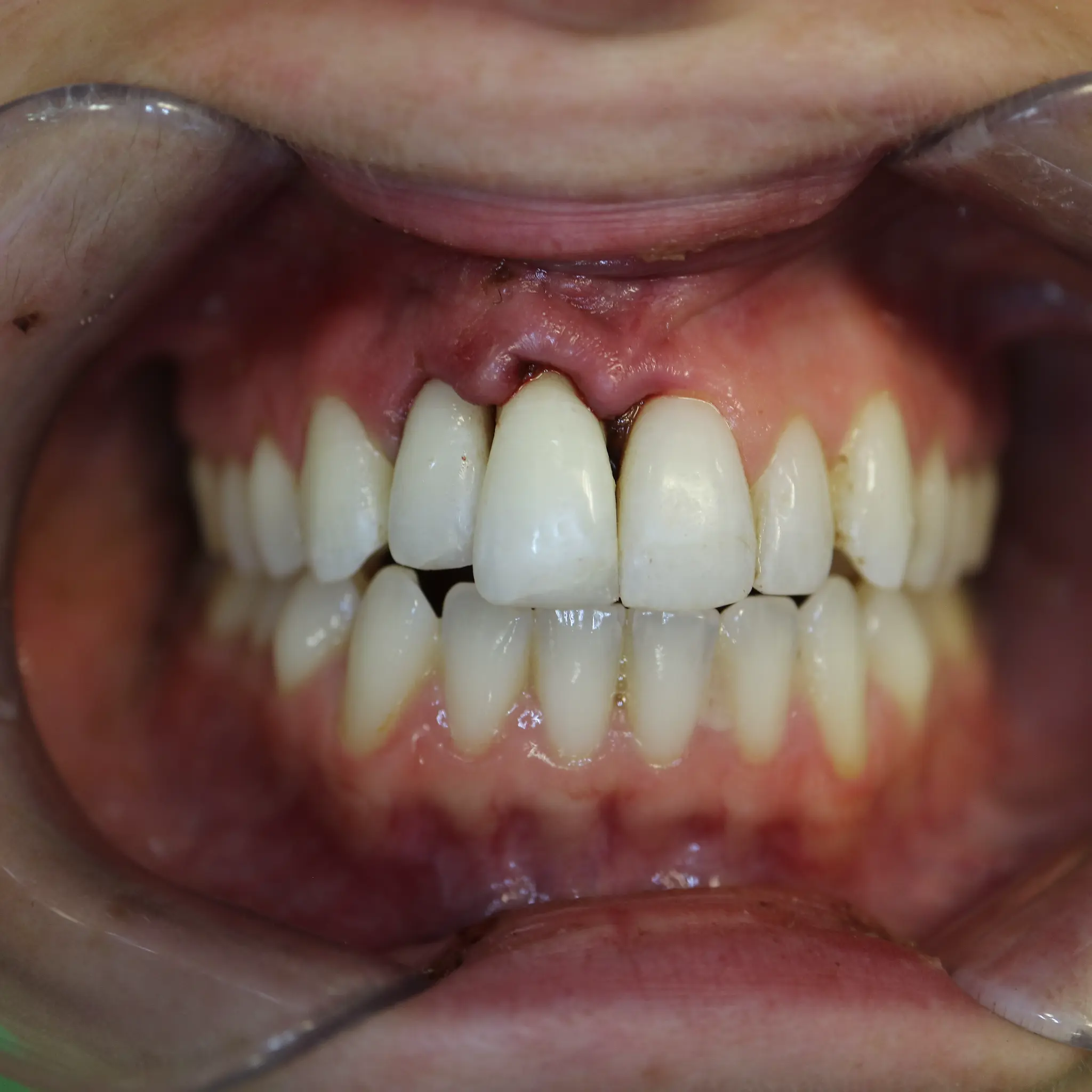 Final clinical result showing complete dental trauma restoration with retractors at Loukas Dentistry Park Ridge IL
