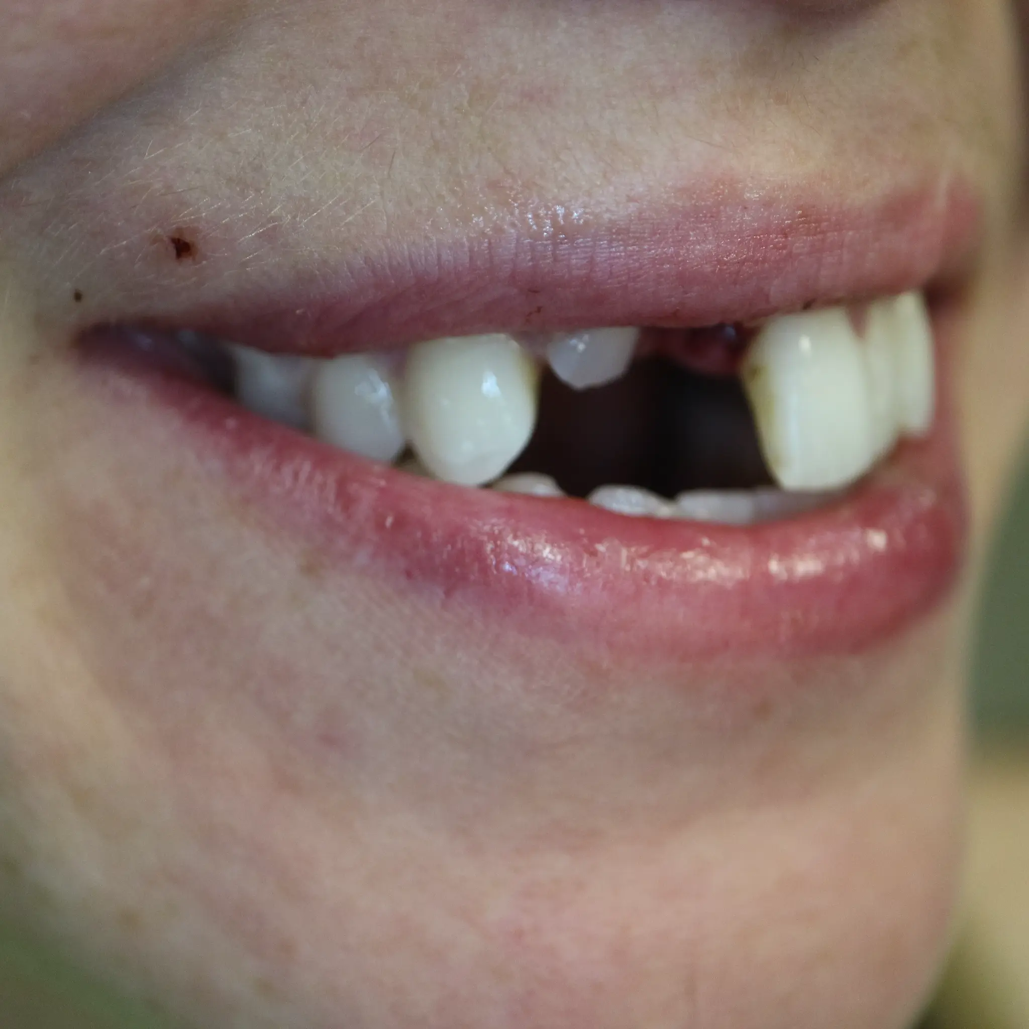 Side view of knocked out front tooth before emergency treatment at Loukas Dentistry Park Ridge