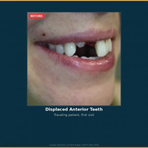 Before photo showing a smiling patient with a displaced upper front tooth and gap where a tooth is missing, for a dental case study.