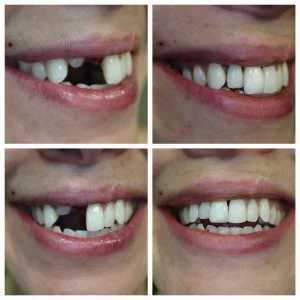Emergency dental case before and after showing same-day tooth replacement at Loukas Dentistry in Park Ridge IL. Four-panel photo: missing front tooth restored with implant crown in a single emergency visit.