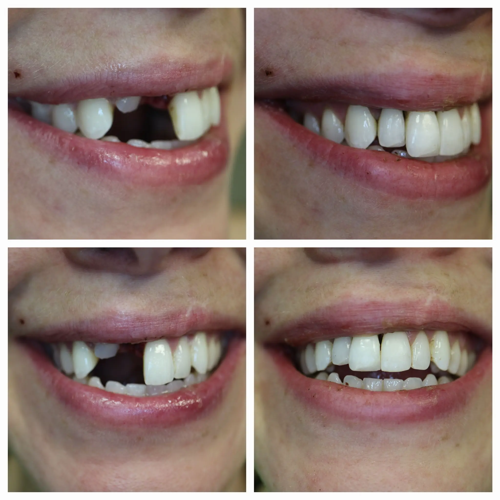 Emergency dentist Park Ridge before and after tooth repair at Loukas Dentistry