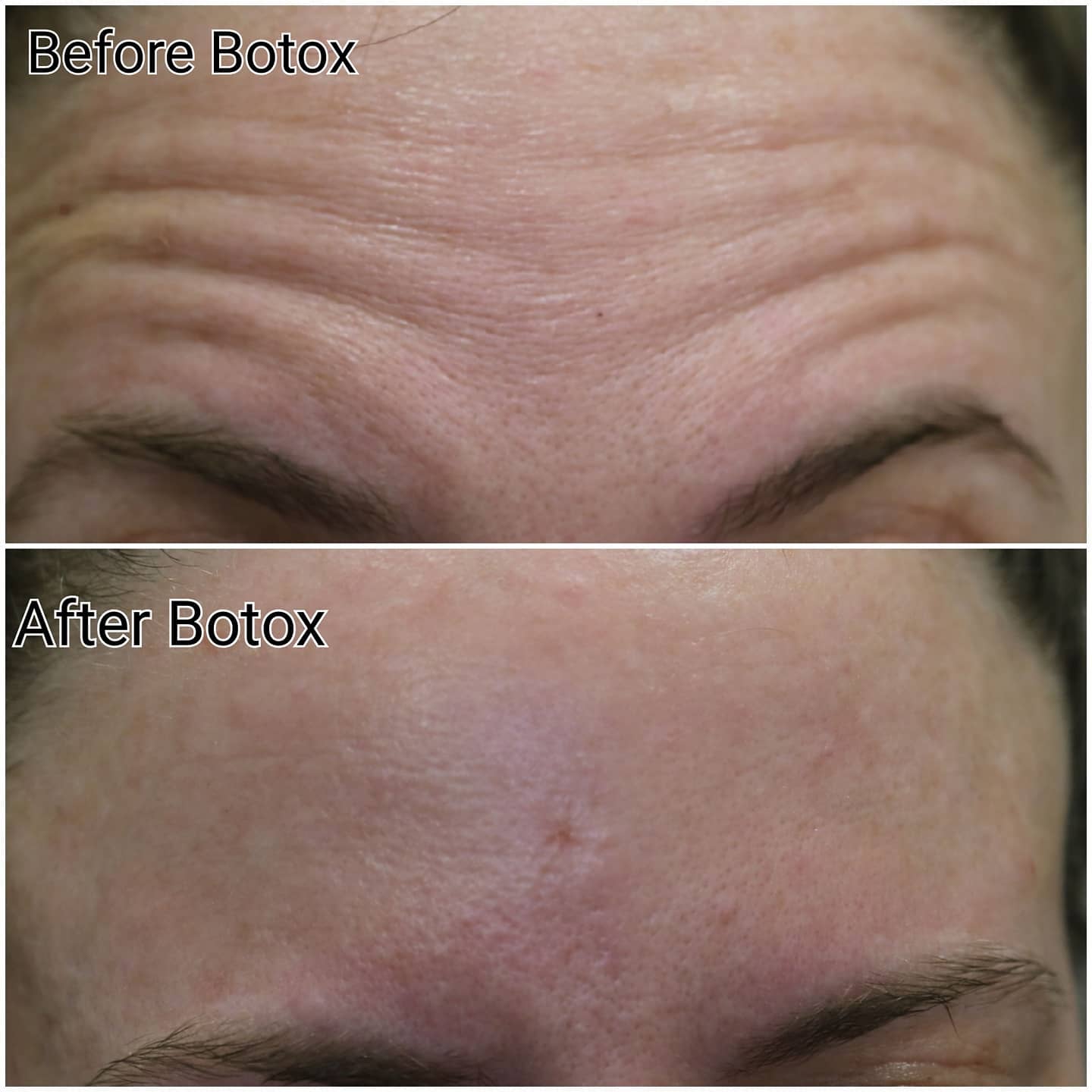Botox before and after photo showing forehead wrinkle reduction at Loukas Dentistry Park Ridge IL