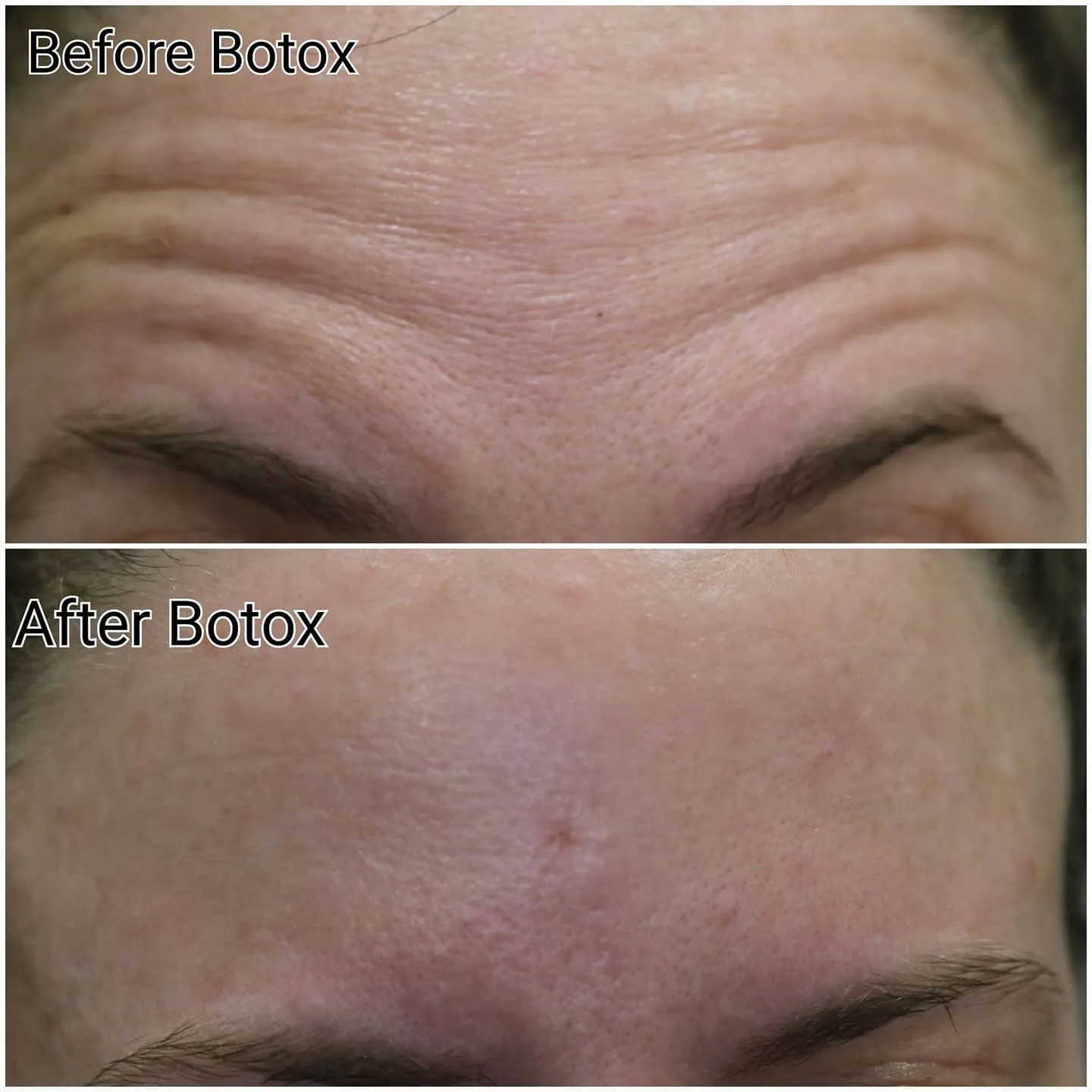 Botox before and after photo showing forehead wrinkle reduction at Loukas Dentistry Park Ridge IL