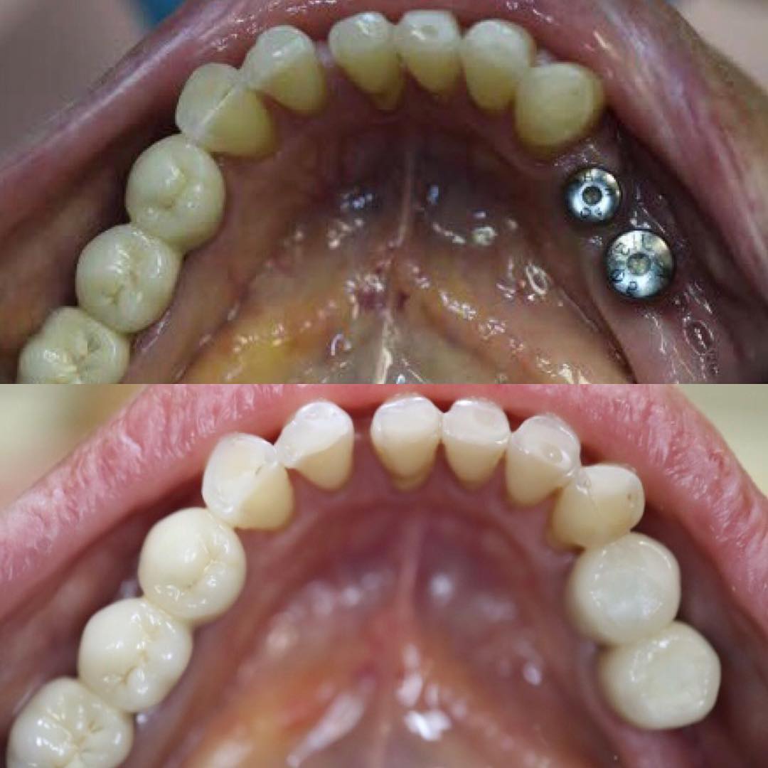 Two dental implant crowns before and after