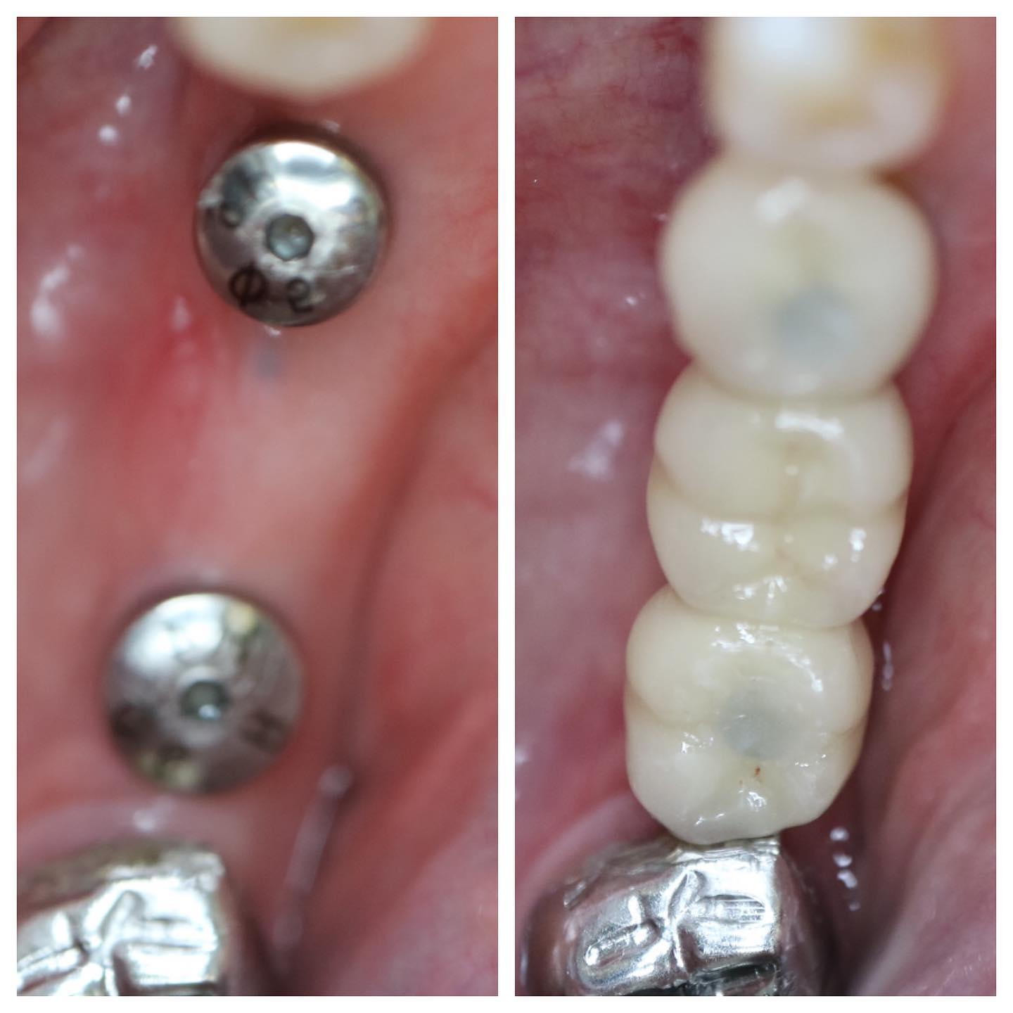Multiple dental implants before and after